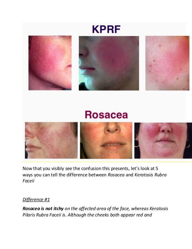 Rosacea or keratosis rubra faceii Rosacea or keratosis rubra faceii