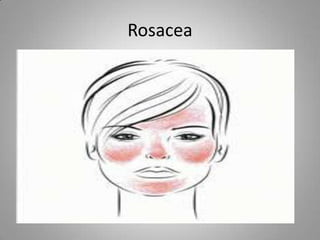Rosacea
• Facial Distribution of Rosacea
•
•
 