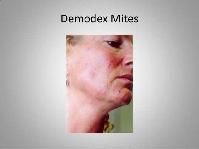 Demodex mites: How I got rid of my papulopustular rosacea ...