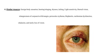 4. Ocular rosacea: foreign body sensation, burning/stinging, dryness, itching, Light sensitivity, blurred vision,
telangiectasia of conjunctiva/lid margin, periocular erythema, blepharitis, meibomian dysfunction,
chalazion, and rarely loss of vision.
 