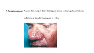3. Phymatous rosacea: Nodular, thickening of skin with irregular surface contours, patulous follicles
•Affects nose, chin, forehead, eyes, or eyelids
 