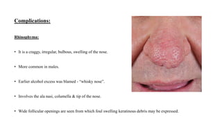 Complications:
Rhinophyma:
• It is a craggy, irregular, bulbous, swelling of the nose.
• More common in males.
• Earlier alcohol excess was blamed - “whisky nose”.
• Involves the ala nasi, columella & tip of the nose.
• Wide follicular openings are seen from which foul swelling keratinous debris may be expressed.
 