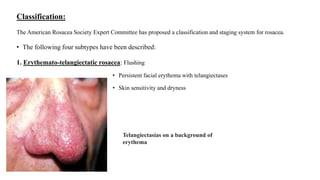 Classification:
The American Rosacea Society Expert Committee has proposed a classification and staging system for rosacea.
• The following four subtypes have been described:
1. Erythemato-telangiectatic rosacea: Flushing
• Persistent facial erythema with telangiectases
• Skin sensitivity and dryness
Telangiectasias on a background of
erythema
 
