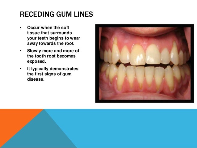 what causes a receding gum lines receding gum line