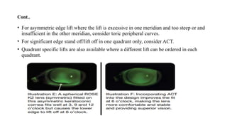 Rose K Lens fitting. pptx | PPTX