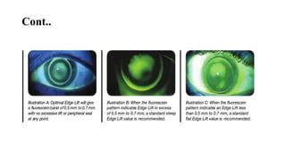 Rose K Lens fitting. pptx | PPTX