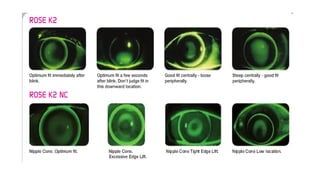 Rose K Lens fitting. pptx | PPTX