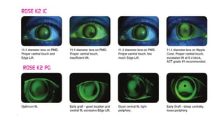 Rose K Lens fitting. pptx | PPTX