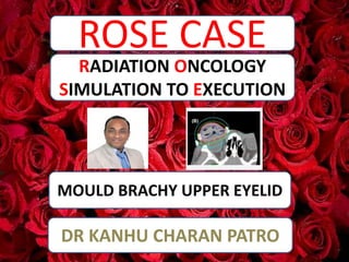 ROSE CASE
MOULD BRACHY UPPER EYELID
RADIATION ONCOLOGY
SIMULATION TO EXECUTION
DR KANHU CHARAN PATRO
 