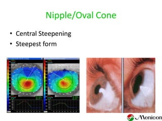 Nipple/Oval Cone
• Central Steepening
• Steepest form
 