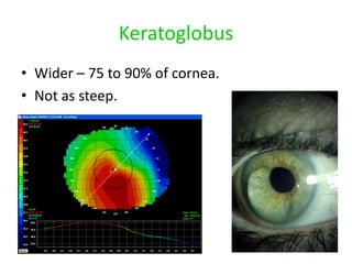 Keratoglobus
• Wider – 75 to 90% of cornea.
• Not as steep.
 