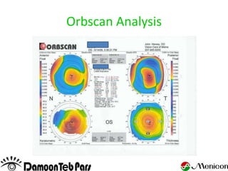 Orbscan Analysis
 