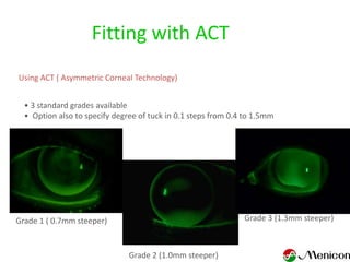 Fitting with ACT
Using ACT ( Asymmetric Corneal Technology)


  • 3 standard grades available
  • Option also to specify degree of tuck in 0.1 steps from 0.4 to 1.5mm




Grade 1 ( 0.7mm steeper)                                       Grade 3 (1.3mm steeper)



                               Grade 2 (1.0mm steeper)
 