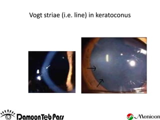 Vogt striae (i.e. line) in keratoconus
 