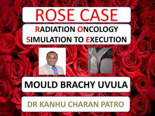 ROSE CASE
MOULD BRACHY UVULA
RADIATION ONCOLOGY
SIMULATION TO EXECUTION
DR KANHU CHARAN PATRO
 