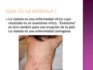 Roseola2 | PPTX