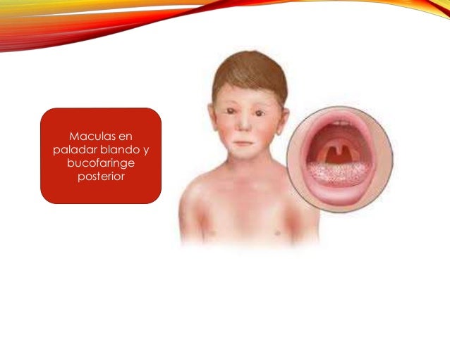 Roseola Rubeola