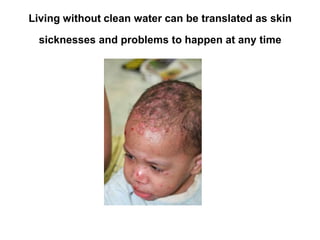 Living without clean water can be translated as skin sicknesses and problems to happen at any time