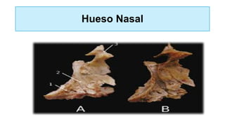 Hueso Nasal
 