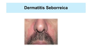 Dermatitis Seborreica
 