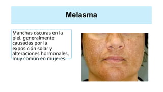 Melasma
Manchas oscuras en la
piel, generalmente
causadas por la
exposición solar y
alteraciones hormonales,
muy común en mujeres.
 