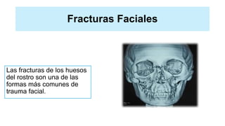 Fracturas Faciales
Las fracturas de los huesos
del rostro son una de las
formas más comunes de
trauma facial.
 