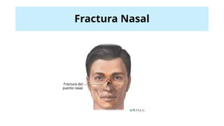 Fractura Nasal
 