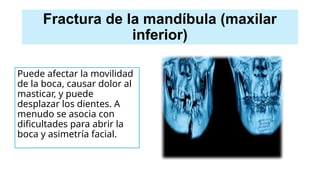 Fractura de la mandíbula (maxilar
inferior)
Puede afectar la movilidad
de la boca, causar dolor al
masticar, y puede
desplazar los dientes. A
menudo se asocia con
dificultades para abrir la
boca y asimetría facial.
 