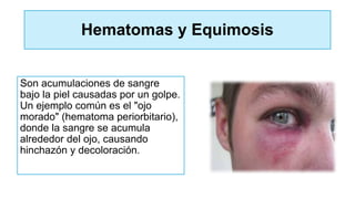 Hematomas y Equimosis
Son acumulaciones de sangre
bajo la piel causadas por un golpe.
Un ejemplo común es el "ojo
morado" (hematoma periorbitario),
donde la sangre se acumula
alrededor del ojo, causando
hinchazón y decoloración.
 