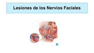 Lesiones de los Nervios Faciales
 