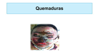 Quemaduras
 