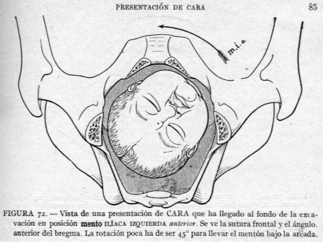 Rotacion en el parto de cara 2 aaa