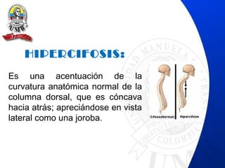 HIPERCIFOSIS:
Es una acentuación de la
curvatura anatómica normal de la
columna dorsal, que es cóncava
hacia atrás; apreciándose en vista
lateral como una joroba.
 