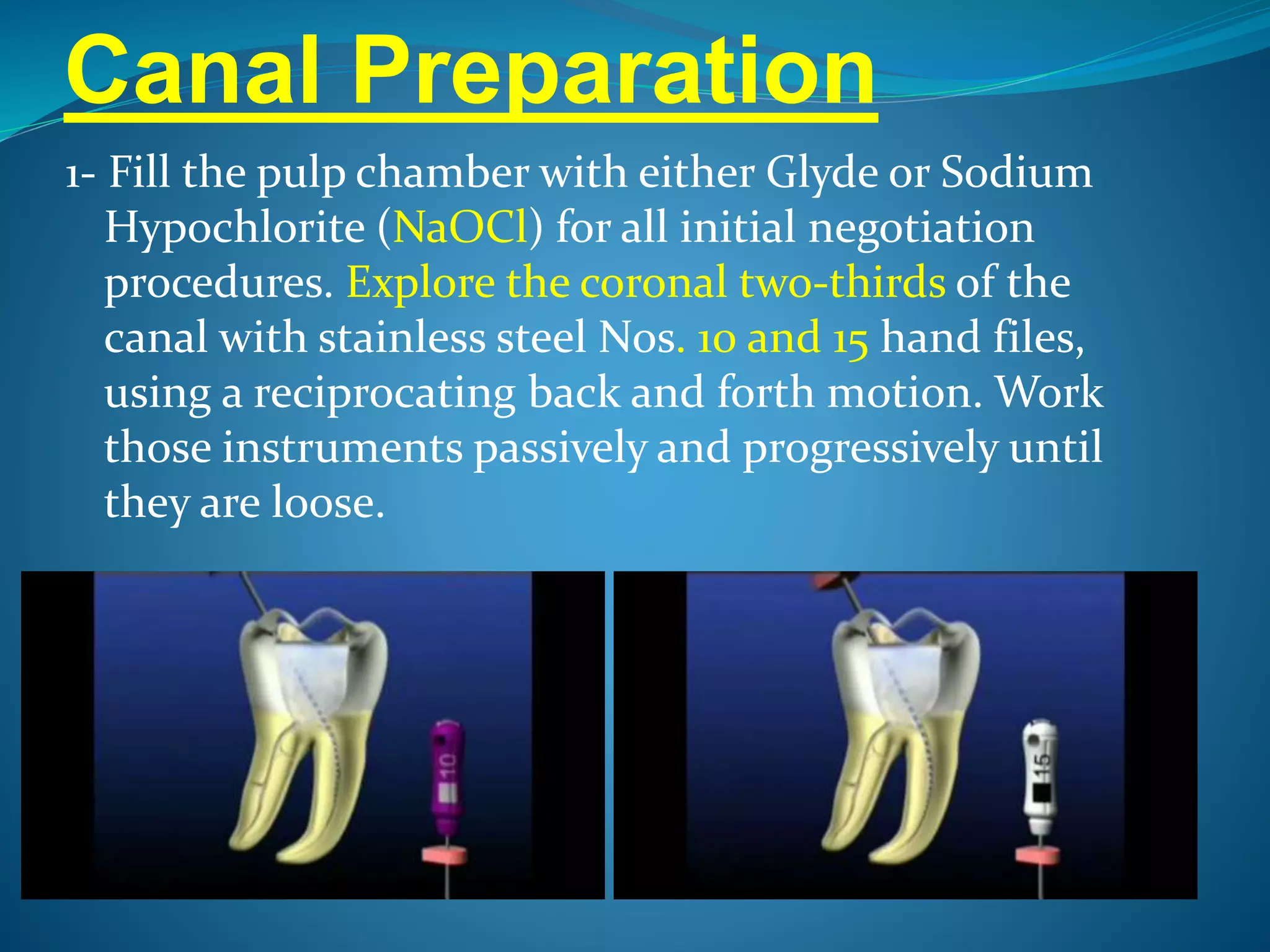 Canal Preparation
1- Fill the pulp chamber with either Glyde or Sodium
Hypochlorite (NaOCl) for all initial negotiation
procedures. Explore the coronal two-thirds of the
canal with stainless steel Nos. 10 and 15 hand files,
using a reciprocating back and forth motion. Work
those instruments passively and progressively until
they are loose.
 
