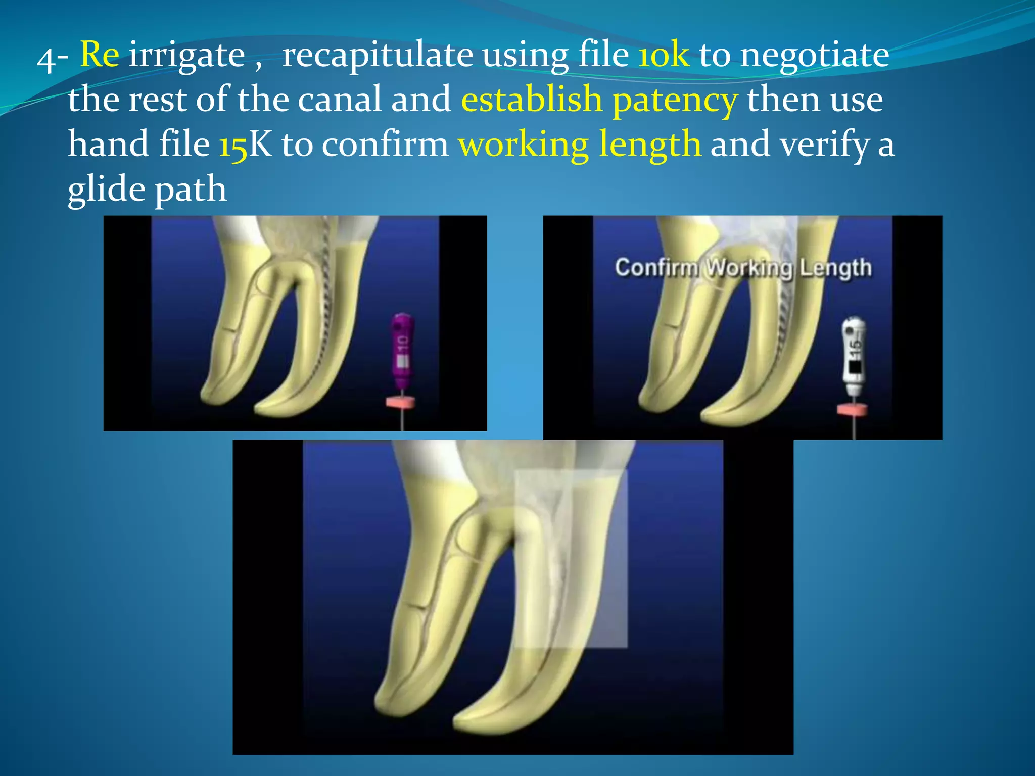 4- Re irrigate , recapitulate using file 10k to negotiate
the rest of the canal and establish patency then use
hand file 15K to confirm working length and verify a
glide path
 