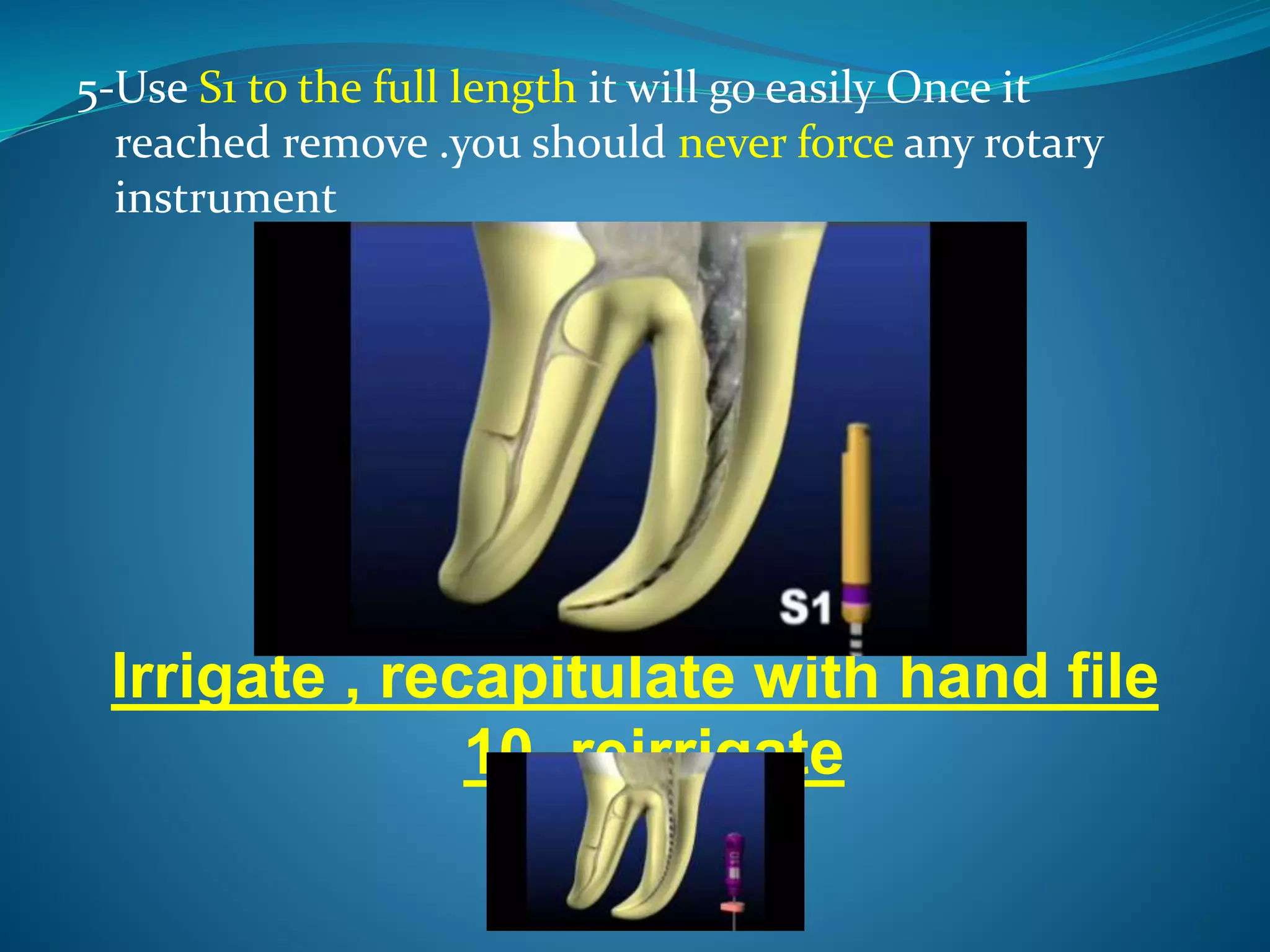 5-Use S1 to the full length it will go easily Once it
reached remove .you should never force any rotary
instrument
Irrigate , recapitulate with hand file
10 ,reirrigate
 