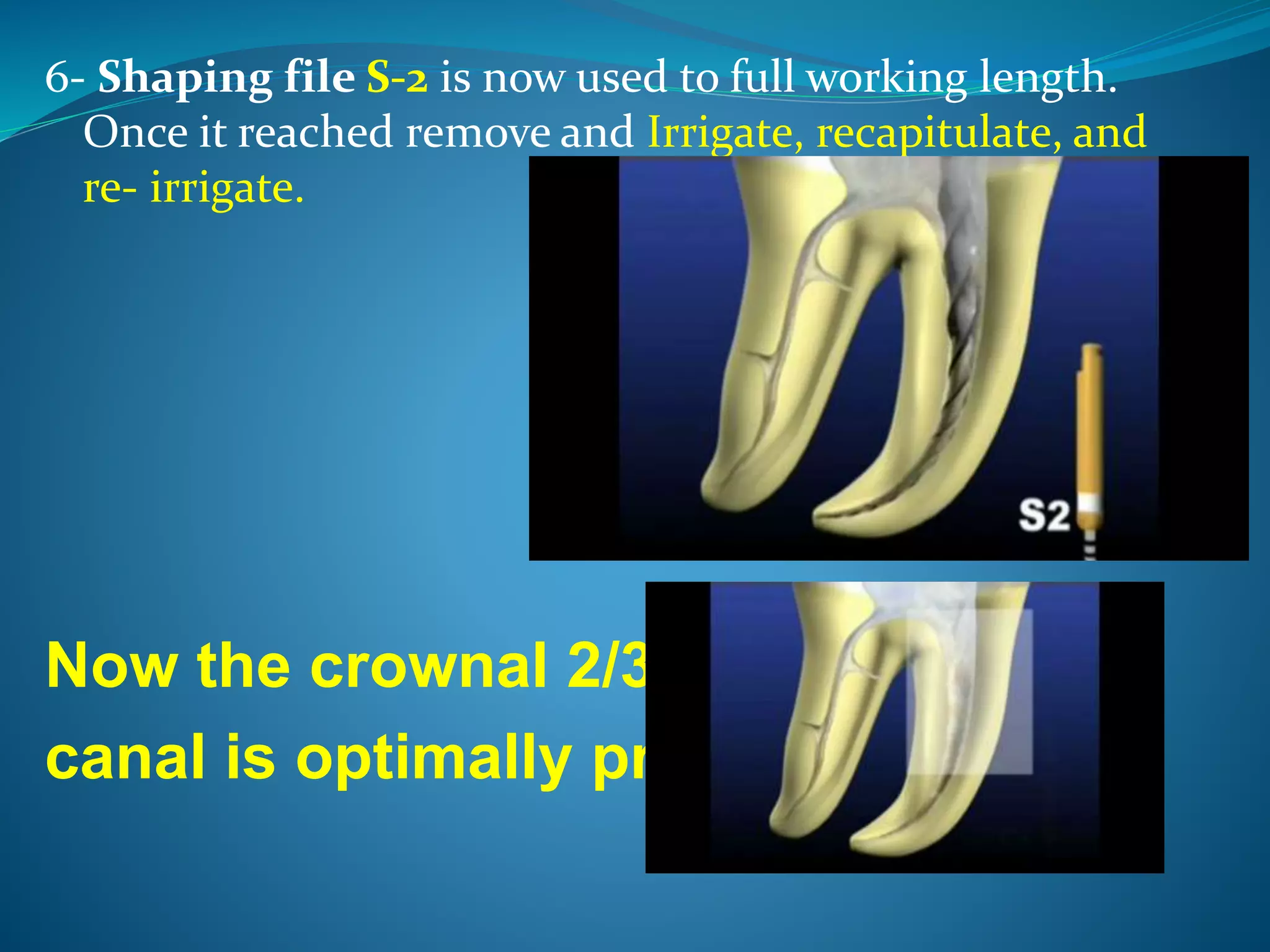 6- Shaping file S-2 is now used to full working length.
Once it reached remove and Irrigate, recapitulate, and
re- irrigate.
Now the crownal 2/3 of the
canal is optimally prepared
 