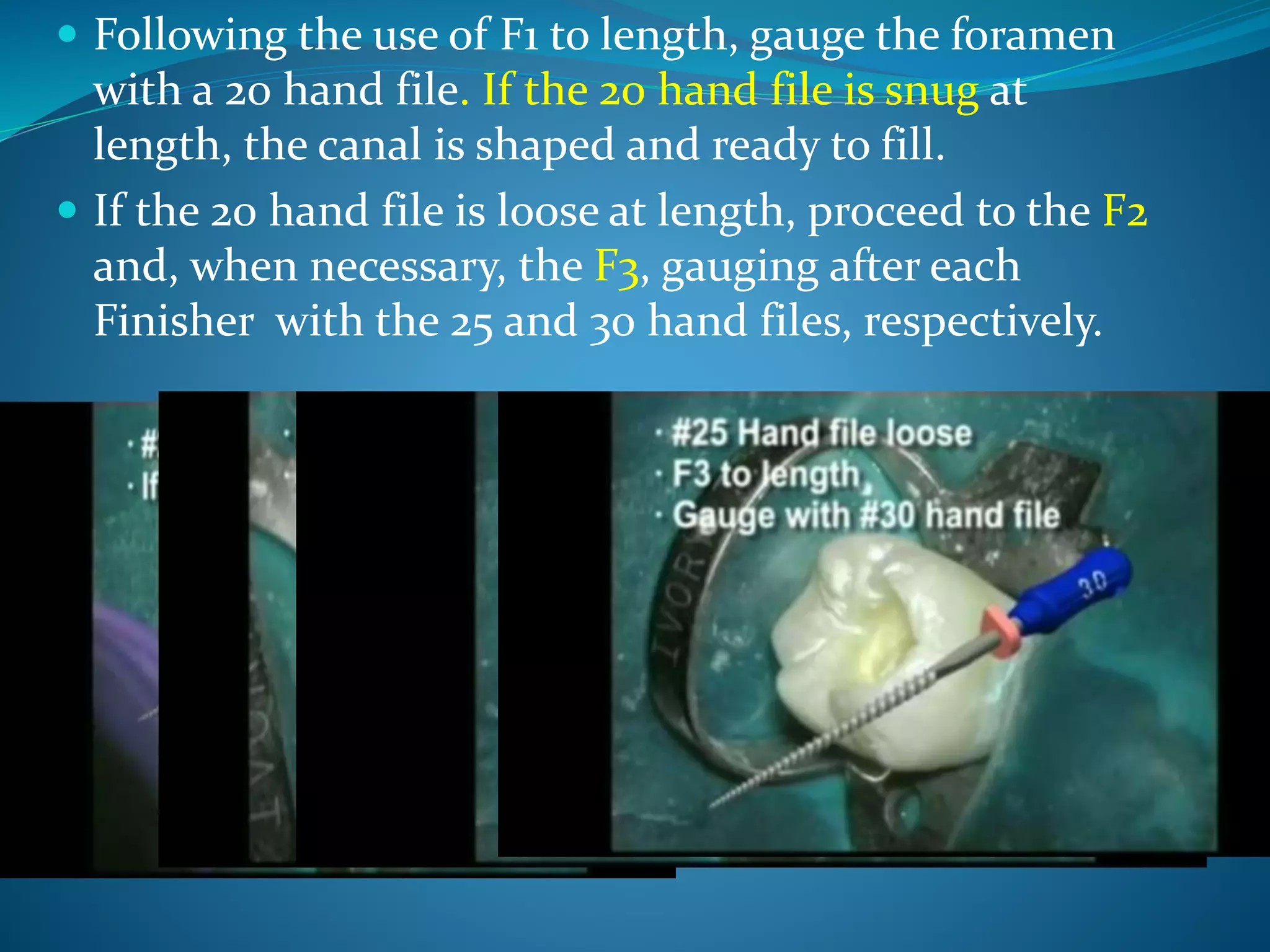  Following the use of F1 to length, gauge the foramen
with a 20 hand file. If the 20 hand file is snug at
length, the canal is shaped and ready to fill.
 If the 20 hand file is loose at length, proceed to the F2
and, when necessary, the F3, gauging after each
Finisher with the 25 and 30 hand files, respectively.
 