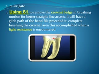 2. re-irrigate
3. Using S1 to remove the crownal ledge in brushing
motion for better straight line access. it will have a
glide path of the hand file preceded it. complete
finishing the crownal area this accomplished when a
light resistance is encountered
 