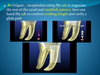 4- Re irrigate , recapitulate using file 10k to negotiate
the rest of the canal and establish patency then use
hand file 15K to confirm working length and verify a
glide path
 