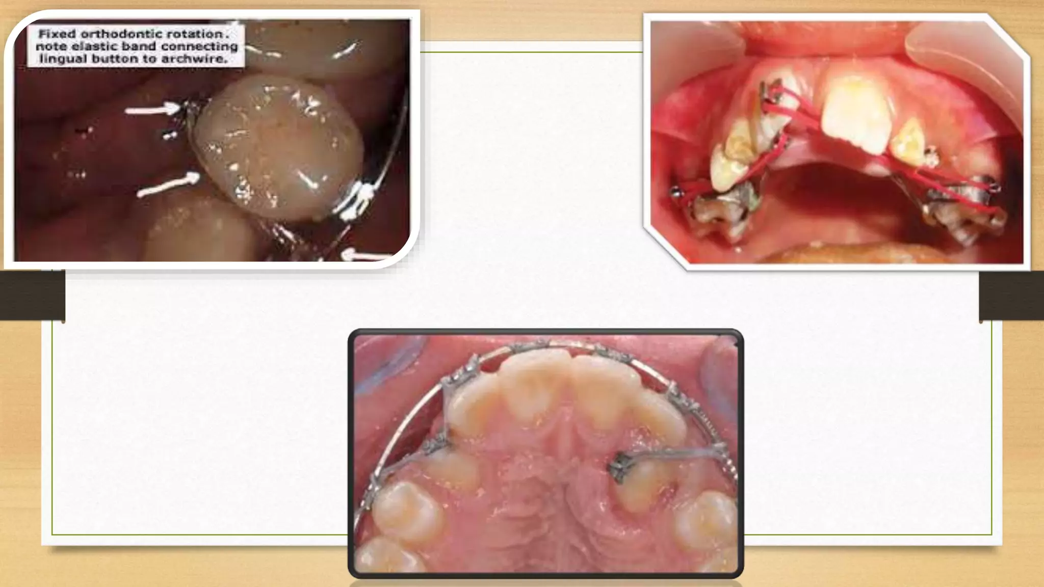 Rotation of teeth & its management | PPTX