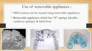 USE OF FIXED APPLIANCES :
• It is the most appropriate mode of treatment when there are
multiple rotated teeth present.
• ...