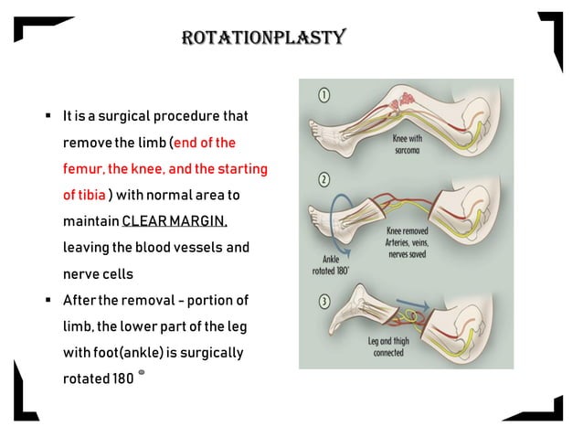 Rotationplasty | PDF | Bone and Joint Conditions | Diseases and Conditions