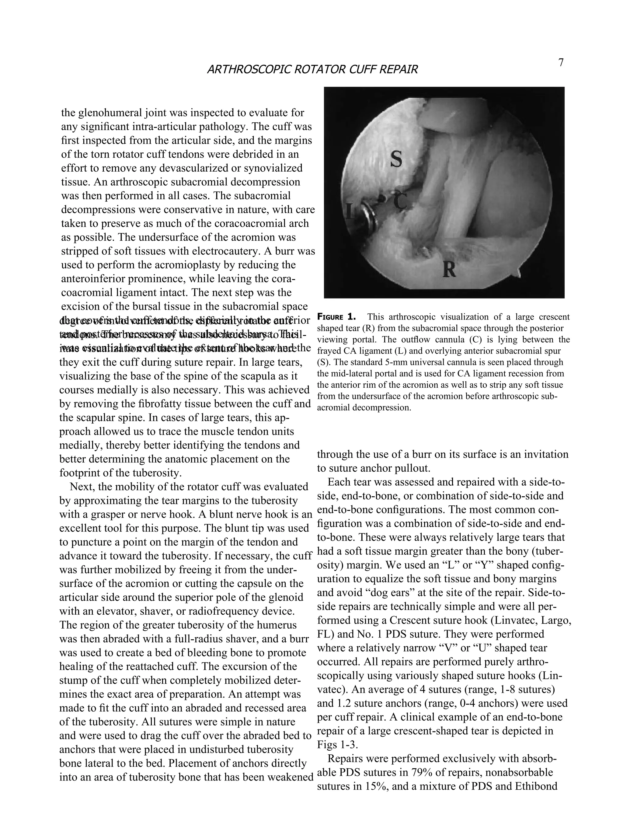 degree of involvement of the different rotator cuff tendons. The bursectomy was also necessary to facil- itate visualization of the tips of suture hooks where they exit the cuff during suture repair. In large tears, visualizing the base of the spine of the scapula as it courses medially is also necessary. This was achieved by removing the ﬁbrofatty tissue between the cuff and the scapular spine. In cases of large tears, this ap- proach allowed us to trace the muscle tendon units medially, thereby better identifying the tendons and better determining the anatomic placement on the footprint of the tuberosity. Next, the mobility of the  rotator cuff  was evaluated by approximating the tear margins to the tuberosity with a grasper or nerve hook. A blunt nerve hook is an excellent tool for this purpose. The blunt tip was used to puncture a point on the margin of the tendon and advance it toward the tuberosity. If necessary, the cuff was further mobilized by freeing it from the under- surface of the acromion or cutting the capsule on the articular side around the superior pole of the glenoid with an elevator, shaver, or radiofrequency device. The region of the greater tuberosity of the humerus was then abraded with a full-radius shaver, and a burr was used to create a bed of bleeding bone to promote healing of the reattached cuff. The excursion of the stump of the cuff when completely mobilized deter- mines the exact area of preparation. An attempt was made to ﬁt the cuff into an abraded and recessed area of the tuberosity. All sutures were simple in nature and were used to drag the cuff over the abraded bed to anchors that were placed in undisturbed tuberosity bone lateral to the bed. Placement of anchors directly into an area of tuberosity bone that has been weakened F IGURE  1.  This  arthroscopic  visualization  of  a  large  crescent shaped tear (R) from the subacromial space through the posterior viewing  portal.  The  outﬂow  cannula  (C)  is  lying  between  the frayed CA ligament (L) and overlying anterior subacromial spur (S). The standard 5-mm universal cannula is seen placed through the mid-lateral portal and is used for CA ligament recession from the anterior rim of the acromion as well as to strip any soft tissue from the undersurface of the acromion before arthroscopic sub- acromial decompression. through the use of a burr on its surface is an invitation to suture anchor pullout. Each tear was assessed and repaired with a side-to- side, end-to-bone, or combination of side-to-side and end-to-bone conﬁgurations. The most common con- ﬁ guration was a combination of side-to-side and end- to-bone. These were always relatively large tears that had a soft tissue margin greater than the bony (tuber- osity) margin. We used an “L” or “Y” shaped conﬁg- uration to equalize the soft tissue and bony margins and avoid “dog ears” at the site of the repair. Side-to- side repairs are technically simple and were all per- formed using a Crescent suture hook (Linvatec, Largo, FL) and No. 1 PDS suture. They were performed where a relatively narrow “V” or “U” shaped tear occurred. All repairs are performed purely arthro- scopically using variously shaped suture hooks (Lin- vatec). An average of 4 sutures (range, 1-8 sutures) and 1.2 suture anchors (range, 0-4 anchors) were used per cuff repair. A clinical example of an end-to-bone repair of a large crescent-shaped tear is depicted in Figs 1-3. Repairs were performed exclusively with absorb- able PDS sutures in 79% of repairs, nonabsorbable sutures in 15%, and a mixture of PDS and Ethibond 7 ARTHROSCOPIC ROTATOR CUFF REPAIR the glenohumeral joint was inspected to evaluate for any signiﬁcant intra-articular pathology. The cuff was ﬁ rst inspected from the articular side, and the margins of the torn rotator cuff tendons were debrided in an effort to remove any devascularized or synovialized tissue. An arthroscopic subacromial decompression was then performed in all cases. The subacromial decompressions were conservative in nature, with care taken to preserve as much of the coracoacromial arch as possible. The undersurface of the acromion was stripped of soft tissues with electrocautery. A burr was used to perform the acromioplasty by reducing the anteroinferior prominence, while leaving the cora- coacromial ligament intact. The next step was the excision of the bursal tissue in the subacromial space that covers the cuff tendons, especially in the anterior and posterior recesses of the subdeltoid bursa. This was essential to evaluate the extent of the tear and the 