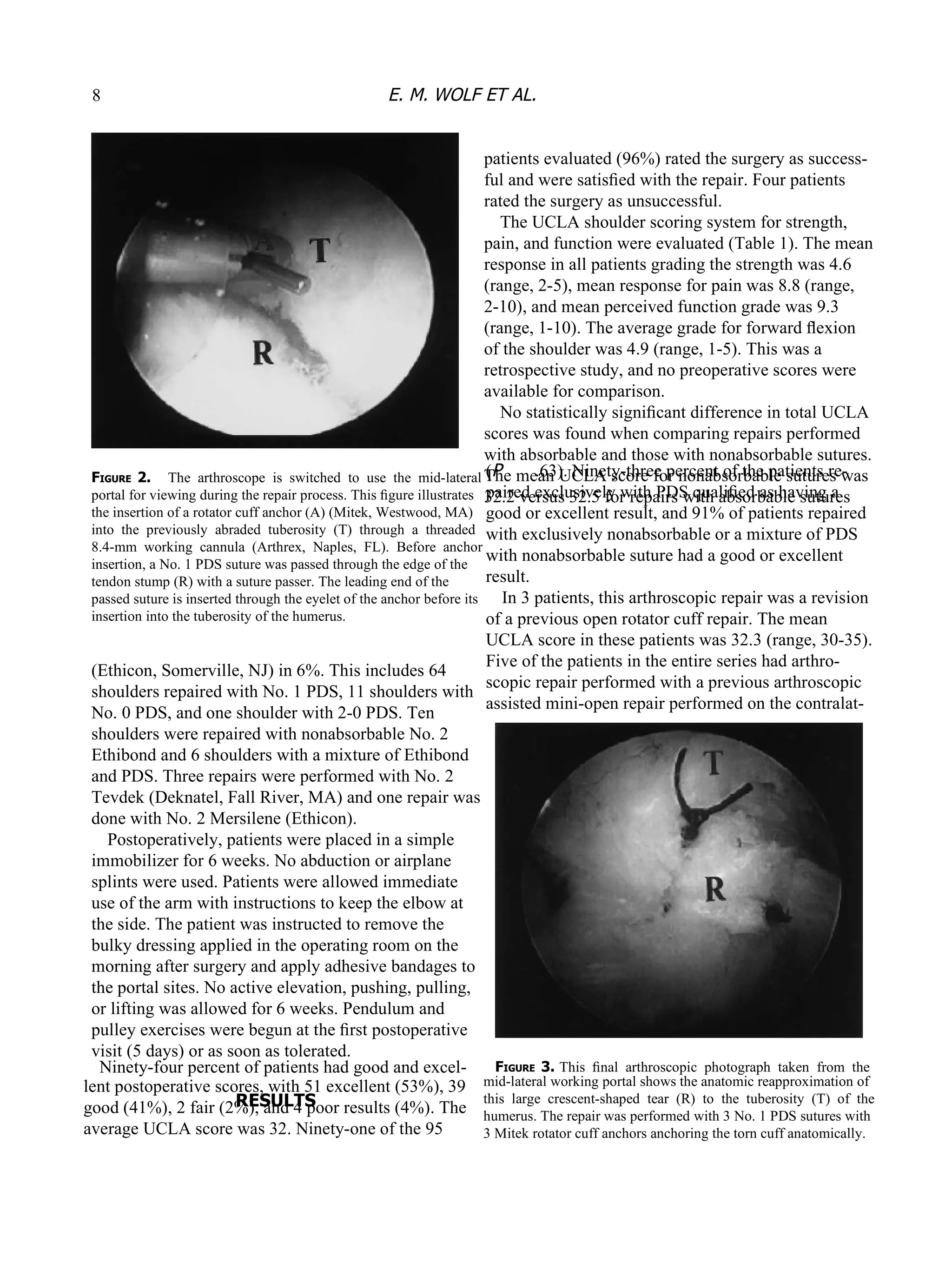 Ninety-four percent of patients had good and excel- lent postoperative scores, with 51 excellent (53%), 39 good (41%), 2 fair (2%), and 4 poor results (4%). The average UCLA score was 32. Ninety-one of the 95 ( P  .63). Ninety-three percent of the patients re- paired exclusively with PDS qualiﬁed as having a good or excellent result, and 91% of patients repaired with exclusively nonabsorbable or a mixture of PDS with nonabsorbable suture had a good or excellent result. In 3 patients, this arthroscopic repair was a revision of a previous open rotator cuff repair. The mean UCLA score in these patients was 32.3 (range, 30-35). Five of the patients in the entire series had arthro- scopic repair performed with a previous arthroscopic assisted mini-open repair performed on the contralat- F IGURE  3. This  ﬁnal  arthroscopic  photograph  taken  from  the mid-lateral working portal shows the anatomic reapproximation of this  large  crescent-shaped  tear  (R)  to  the  tuberosity  (T)  of  the humerus. The repair was performed with 3 No. 1 PDS sutures with 3 Mitek rotator cuff anchors anchoring the torn cuff anatomically. F IGURE  2.  The  arthroscope  is  switched  to  use  the  mid-lateral portal for viewing during the repair process. This ﬁgure illustrates the insertion of a rotator cuff anchor (A) (Mitek, Westwood, MA) into  the  previously  abraded  tuberosity  (T)  through  a  threaded 8.4-mm  working  cannula  (Arthrex,  Naples,  FL).  Before  anchor insertion, a No. 1 PDS suture was passed through the edge of the tendon stump (R) with a suture passer. The leading end of the passed suture is inserted through the eyelet of the anchor before its insertion into the tuberosity of the humerus. (Ethicon, Somerville, NJ) in 6%. This includes 64 shoulders repaired  with No. 1 PDS, 11 shoulders with No. 0 PDS, and one shoulder with 2-0 PDS. Ten shoulders were repaired with nonabsorbable No. 2 Ethibond and 6 shoulders with a mixture of Ethibond and PDS. Three repairs were performed with No. 2 Tevdek (Deknatel, Fall River, MA) and one repair was done with No. 2 Mersilene (Ethicon). Postoperatively, patients were placed in a simple immobilizer for 6 weeks. No abduction or airplane splints were used. Patients were allowed immediate use of the arm with instructions to keep the elbow at the side. The patient was instructed to remove the bulky dressing applied in the operating room on the morning after surgery and apply adhesive bandages to the portal sites. No active elevation, pushing, pulling, or lifting was allowed for 6 weeks. Pendulum and pulley exercises were begun at the ﬁrst postoperative visit (5 days) or as soon as tolerated. RESULTS 8 E. M. WOLF ET AL. patients evaluated (96%) rated the surgery as success- ful and were satisﬁed with the repair. Four patients rated the surgery as unsuccessful. The UCLA shoulder scoring system for strength, pain, and function were evaluated (Table 1). The mean response in all patients grading the strength was 4.6 (range, 2-5), mean response for pain was 8.8 (range, 2-10), and mean perceived function grade was 9.3 (range, 1-10). The average grade for forward ﬂexion of the shoulder was 4.9 (range, 1-5). This was a retrospective study, and no preoperative scores were available for comparison. No statistically signiﬁcant difference in total UCLA scores was found when comparing repairs performed with absorbable and those with nonabsorbable sutures. The mean UCLA score for nonabsorbable sutures was 32.2 versus 32.5 for repairs with absorbable sutures 
