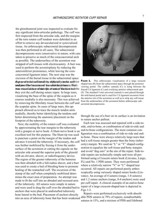 degree of involvement of the different rotator cuff tendons. The bursectomy was also necessary to facil- itate visualization of the tips of suture hooks where they exit the cuff during suture repair. In large tears, visualizing the base of the spine of the scapula as it courses medially is also necessary. This was achieved by removing the ﬁbrofatty tissue between the cuff and the scapular spine. In cases of large tears, this ap- proach allowed us to trace the muscle tendon units medially, thereby better identifying the tendons and better determining the anatomic placement on the footprint of the tuberosity. Next, the mobility of the  rotator cuff  was evaluated by approximating the tear margins to the tuberosity with a grasper or nerve hook. A blunt nerve hook is an excellent tool for this purpose. The blunt tip was used to puncture a point on the margin of the tendon and advance it toward the tuberosity. If necessary, the cuff was further mobilized by freeing it from the under- surface of the acromion or cutting the capsule on the articular side around the superior pole of the glenoid with an elevator, shaver, or radiofrequency device. The region of the greater tuberosity of the humerus was then abraded with a full-radius shaver, and a burr was used to create a bed of bleeding bone to promote healing of the reattached cuff. The excursion of the stump of the cuff when completely mobilized deter- mines the exact area of preparation. An attempt was made to ﬁt the cuff into an abraded and recessed area of the tuberosity. All sutures were simple in nature and were used to drag the cuff over the abraded bed to anchors that were placed in undisturbed tuberosity bone lateral to the bed. Placement of anchors directly into an area of tuberosity bone that has been weakened F IGURE  1.  This  arthroscopic  visualization  of  a  large  crescent shaped tear (R) from the subacromial space through the posterior viewing  portal.  The  outﬂow  cannula  (C)  is  lying  between  the frayed CA ligament (L) and overlying anterior subacromial spur (S). The standard 5-mm universal cannula is seen placed through the mid-lateral portal and is used for CA ligament recession from the anterior rim of the acromion as well as to strip any soft tissue from the undersurface of the acromion before arthroscopic sub- acromial decompression. through the use of a burr on its surface is an invitation to suture anchor pullout. Each tear was assessed and repaired with a side-to- side, end-to-bone, or combination of side-to-side and end-to-bone conﬁgurations. The most common con- ﬁ guration was a combination of side-to-side and end- to-bone. These were always relatively large tears that had a soft tissue margin greater than the bony (tuber- osity) margin. We used an “L” or “Y” shaped conﬁg- uration to equalize the soft tissue and bony margins and avoid “dog ears” at the site of the repair. Side-to- side repairs are technically simple and were all per- formed using a Crescent suture hook (Linvatec, Largo, FL) and No. 1 PDS suture. They were performed where a relatively narrow “V” or “U” shaped tear occurred. All repairs are performed purely arthro- scopically using variously shaped suture hooks (Lin- vatec). An average of 4 sutures (range, 1-8 sutures) and 1.2 suture anchors (range, 0-4 anchors) were used per cuff repair. A clinical example of an end-to-bone repair of a large crescent-shaped tear is depicted in Figs 1-3. Repairs were performed exclusively with absorb- able PDS sutures in 79% of repairs, nonabsorbable sutures in 15%, and a mixture of PDS and Ethibond 7 ARTHROSCOPIC ROTATOR CUFF REPAIR the glenohumeral joint was inspected to evaluate for any signiﬁcant intra-articular pathology. The cuff was ﬁ rst inspected from the articular side, and the margins of the torn rotator cuff tendons were debrided in an effort to remove any devascularized or synovialized tissue. An arthroscopic subacromial decompression was then performed in all cases. The subacromial decompressions were conservative in nature, with care taken to preserve as much of the coracoacromial arch as possible. The undersurface of the acromion was stripped of soft tissues with electrocautery. A burr was used to perform the acromioplasty by reducing the anteroinferior prominence, while leaving the cora- coacromial ligament intact. The next step was the excision of the bursal tissue in the subacromial space that covers the cuff tendons, especially in the anterior and posterior recesses of the subdeltoid bursa. This was essential to evaluate the extent of the tear and the 