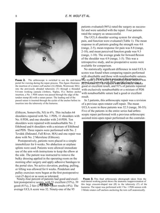 Ninety-four percent of patients had good and excel- lent postoperative scores, with 51 excellent (53%), 39 good (41%), 2 fair (2%), and 4 poor results (4%). The average UCLA score was 32. Ninety-one of the 95 ( P  .63). Ninety-three percent of the patients re- paired exclusively with PDS qualiﬁed as having a good or excellent result, and 91% of patients repaired with exclusively nonabsorbable or a mixture of PDS with nonabsorbable suture had a good or excellent result. In 3 patients, this arthroscopic repair was a revision of a previous open rotator cuff repair. The mean UCLA score in these patients was 32.3 (range, 30-35). Five of the patients in the entire series had arthro- scopic repair performed with a previous arthroscopic assisted mini-open repair performed on the contralat- F IGURE  3. This  ﬁnal  arthroscopic  photograph  taken  from  the mid-lateral working portal shows the anatomic reapproximation of this  large  crescent-shaped  tear  (R)  to  the  tuberosity  (T)  of  the humerus. The repair was performed with 3 No. 1 PDS sutures with 3 Mitek rotator cuff anchors anchoring the torn cuff anatomically. F IGURE  2.  The  arthroscope  is  switched  to  use  the  mid-lateral portal for viewing during the repair process. This ﬁgure illustrates the insertion of a rotator cuff anchor (A) (Mitek, Westwood, MA) into  the  previously  abraded  tuberosity  (T)  through  a  threaded 8.4-mm  working  cannula  (Arthrex,  Naples,  FL).  Before  anchor insertion, a No. 1 PDS suture was passed through the edge of the tendon stump (R) with a suture passer. The leading end of the passed suture is inserted through the eyelet of the anchor before its insertion into the tuberosity of the humerus. (Ethicon, Somerville, NJ) in 6%. This includes 64 shoulders repaired  with No. 1 PDS, 11 shoulders with No. 0 PDS, and one shoulder with 2-0 PDS. Ten shoulders were repaired with nonabsorbable No. 2 Ethibond and 6 shoulders with a mixture of Ethibond and PDS. Three repairs were performed with No. 2 Tevdek (Deknatel, Fall River, MA) and one repair was done with No. 2 Mersilene (Ethicon). Postoperatively, patients were placed in a simple immobilizer for 6 weeks. No abduction or airplane splints were used. Patients were allowed immediate use of the arm with instructions to keep the elbow at the side. The patient was instructed to remove the bulky dressing applied in the operating room on the morning after surgery and apply adhesive bandages to the portal sites. No active elevation, pushing, pulling, or lifting was allowed for 6 weeks. Pendulum and pulley exercises were begun at the ﬁrst postoperative visit (5 days) or as soon as tolerated. RESULTS 8 E. M. WOLF ET AL. patients evaluated (96%) rated the surgery as success- ful and were satisﬁed with the repair. Four patients rated the surgery as unsuccessful. The UCLA shoulder scoring system for strength, pain, and function were evaluated (Table 1). The mean response in all patients grading the strength was 4.6 (range, 2-5), mean response for pain was 8.8 (range, 2-10), and mean perceived function grade was 9.3 (range, 1-10). The average grade for forward ﬂexion of the shoulder was 4.9 (range, 1-5). This was a retrospective study, and no preoperative scores were available for comparison. No statistically signiﬁcant difference in total UCLA scores was found when comparing repairs performed with absorbable and those with nonabsorbable sutures. The mean UCLA score for nonabsorbable sutures was 32.2 versus 32.5 for repairs with absorbable sutures 