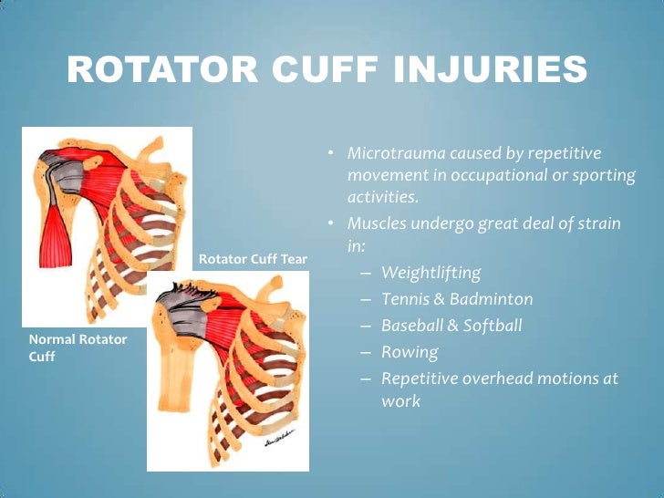Your Treatment for Rotator Cuff