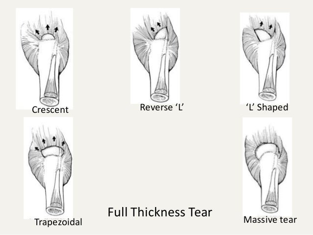 Rotator cuff Tear and its management