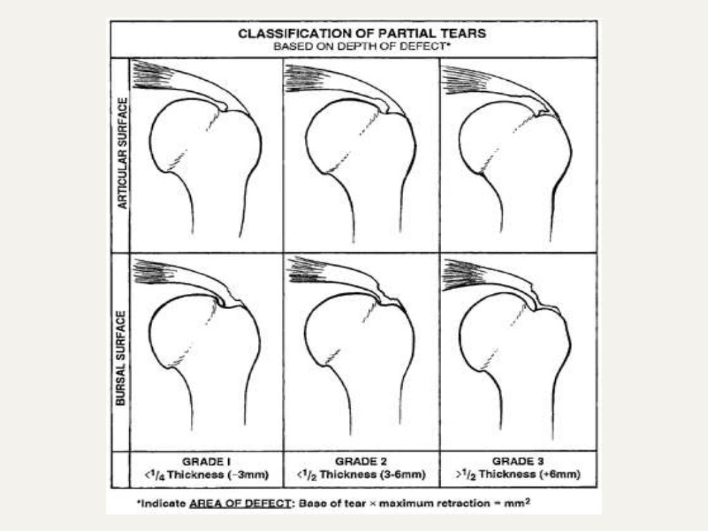 Rotator cuff Tear and its management